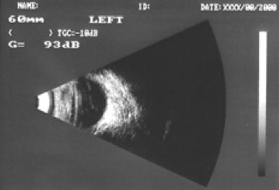 ultrasound retinal detatchment