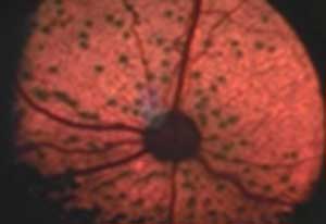 severe retinal dysplasia
